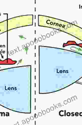 The Glaucomas: Volume II Open Angle Glaucoma And Angle Closure Glaucoma